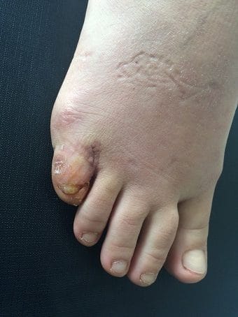Esadattilia del piede destro seconda foto dopo l'intervento