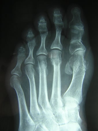 Alluce valgo moderato con metatarsalgia dei raggi centrali piede sinistro seconda foto dopo l'intervento