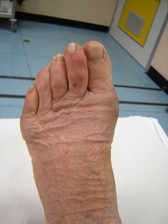 Alluce valgo severo e 5° dito varo piede sinistro prima foto dopo l'intervento