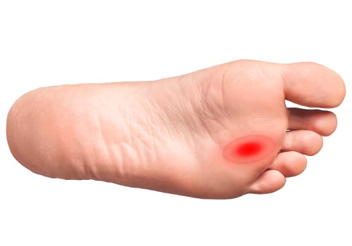 Neuroma di Morton: causa dolore alla pianta del piede tra il terzo e il quadro dito