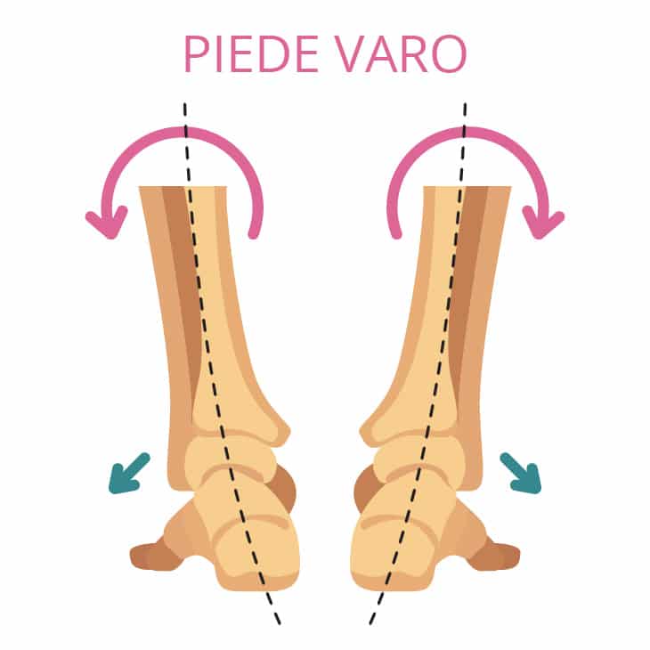 Piede Varo